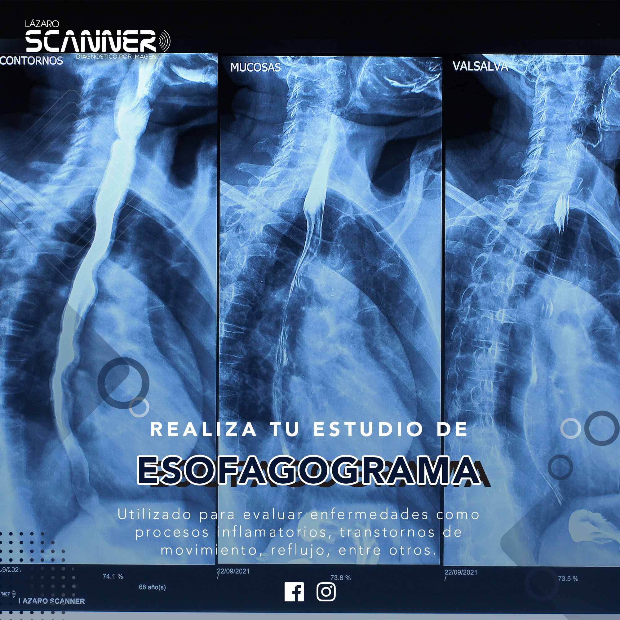 Radiografía Esofagograma