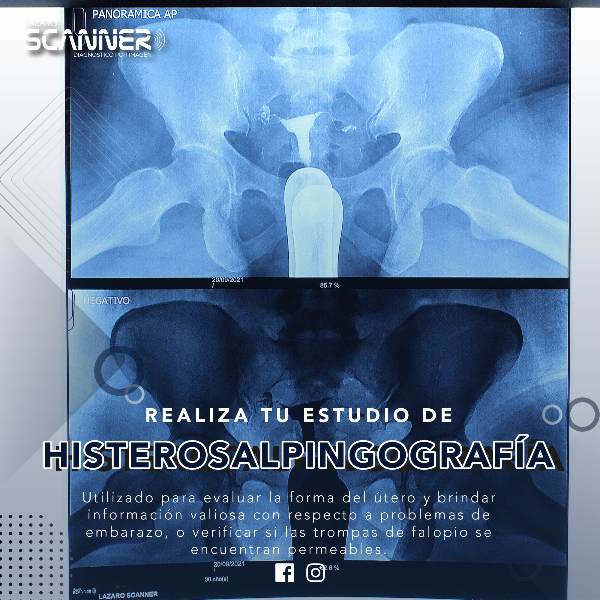 Radiografía Histerosalpingografía