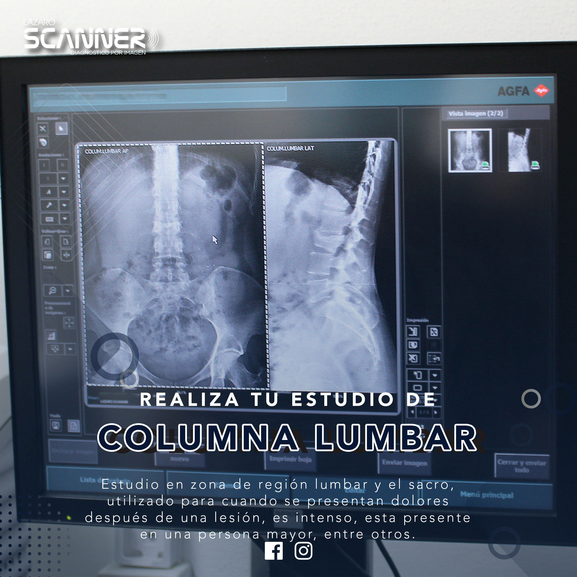 Radiografía Columna Lumbar