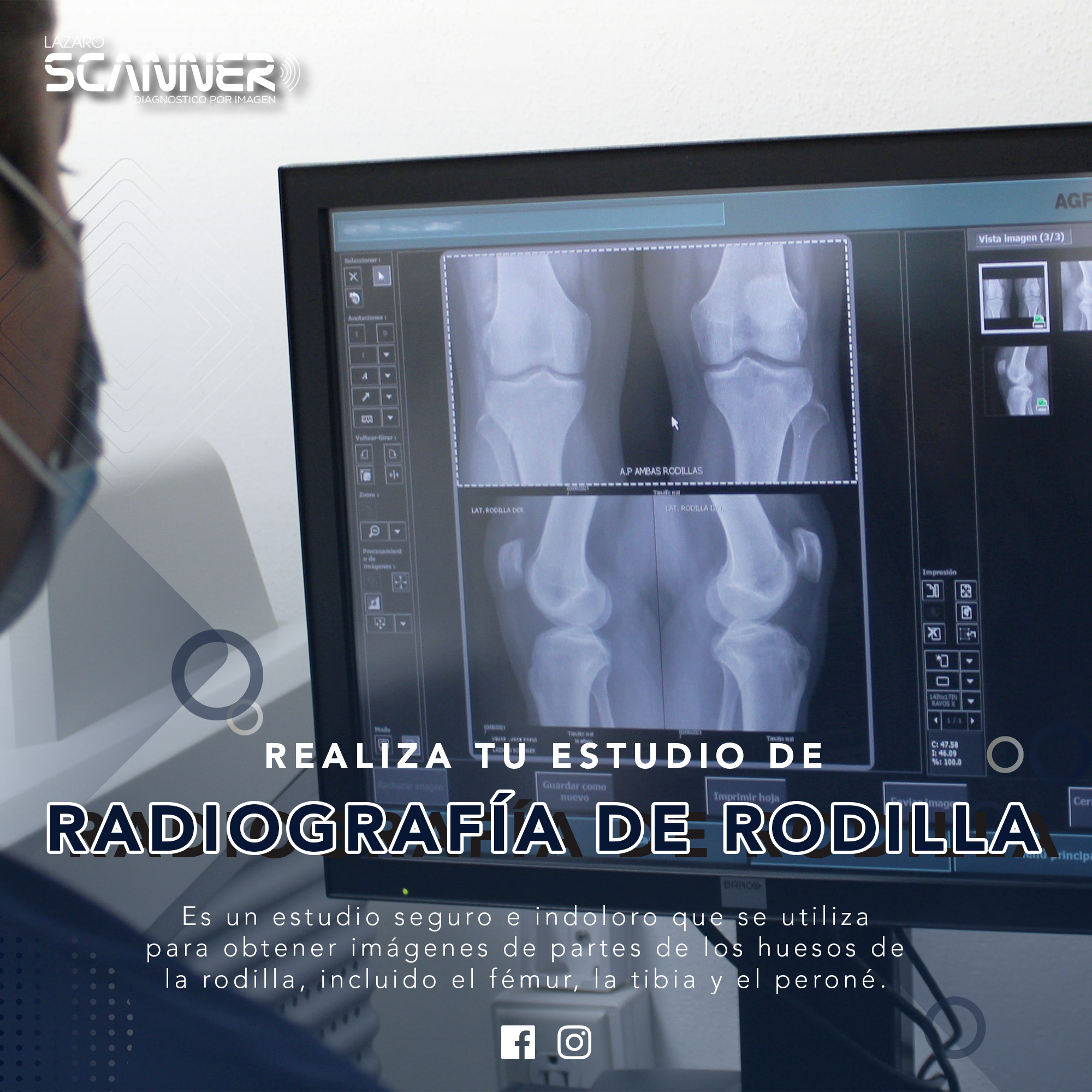 Radiografía Rodilla