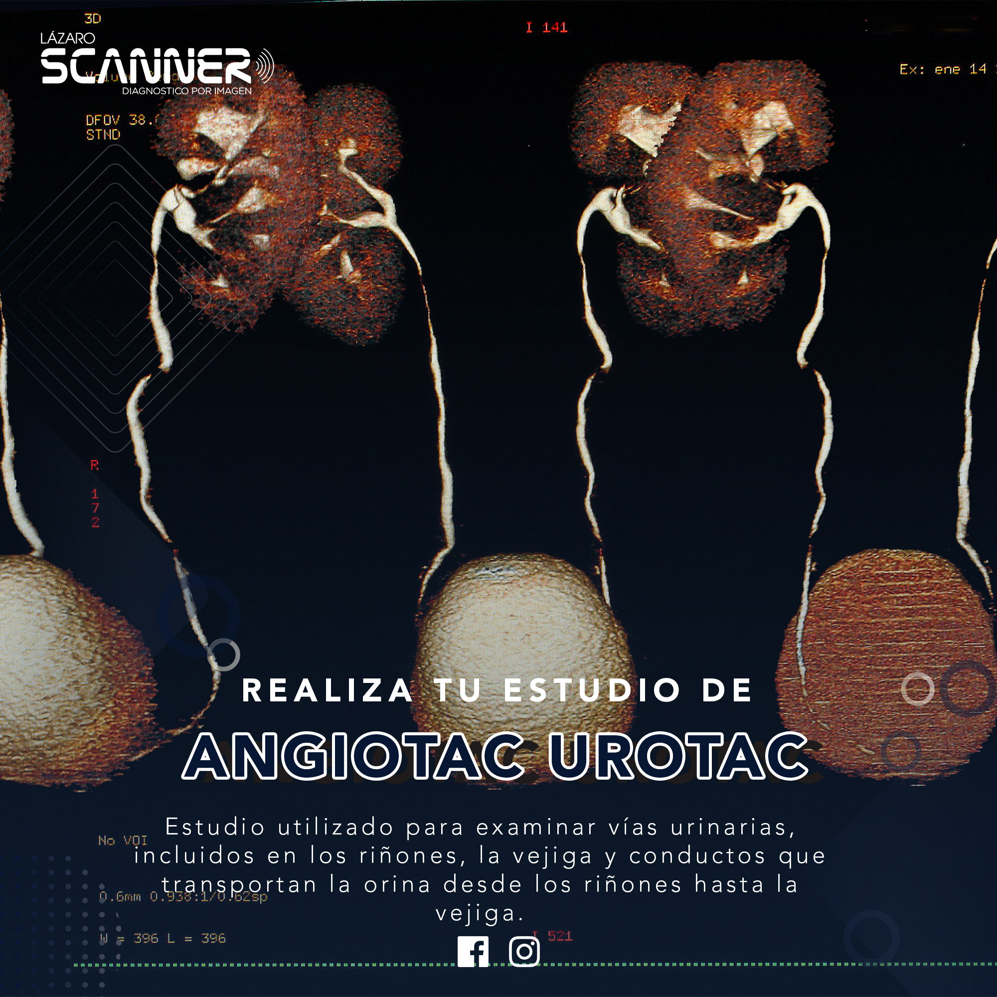 Angiotac Urotac