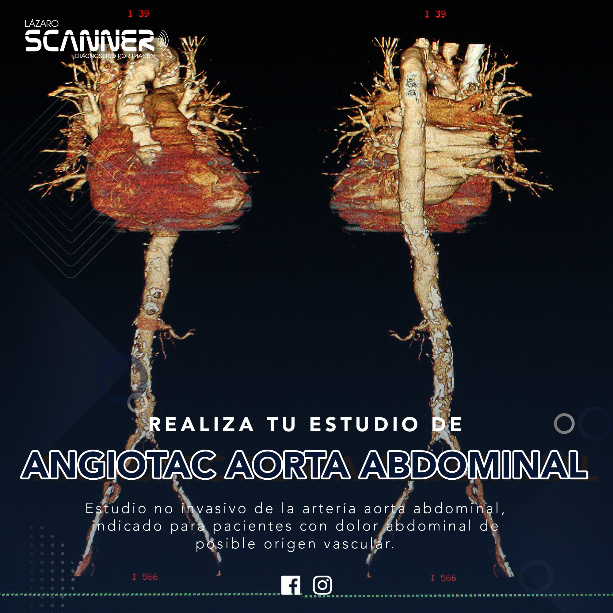 Angiotac Aorta Abdominal