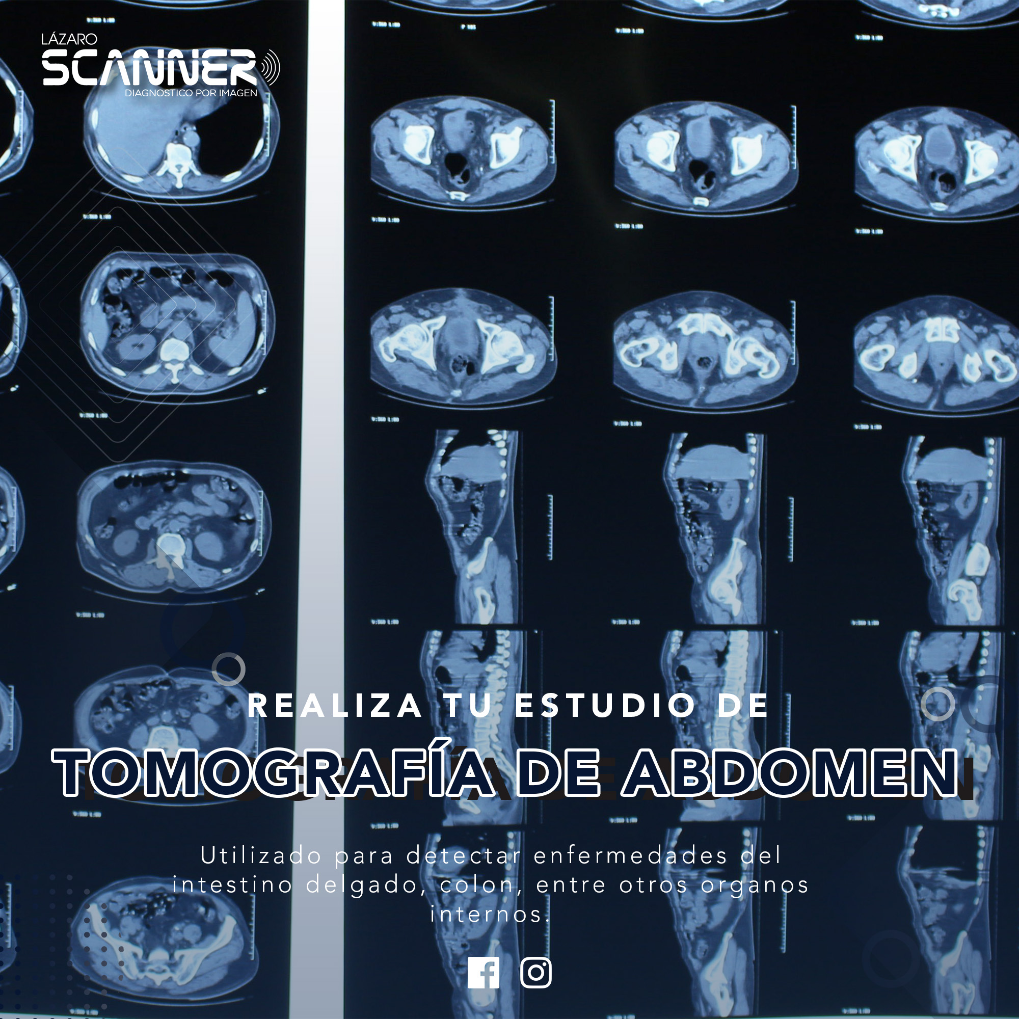 Tomografía de Abdomen