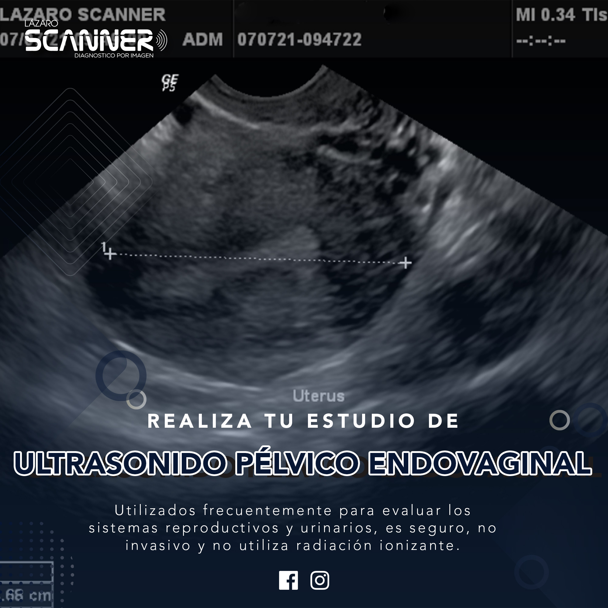 Ultrasonido Pélvico Endovaginal