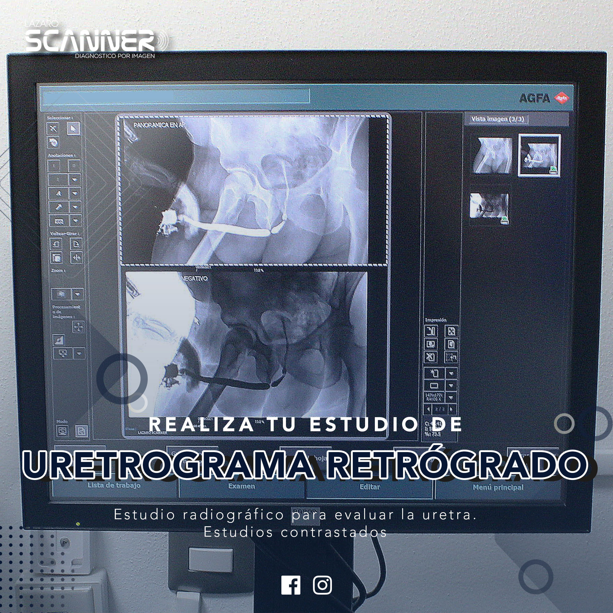 Radiografía Uretrograma Retrógrado